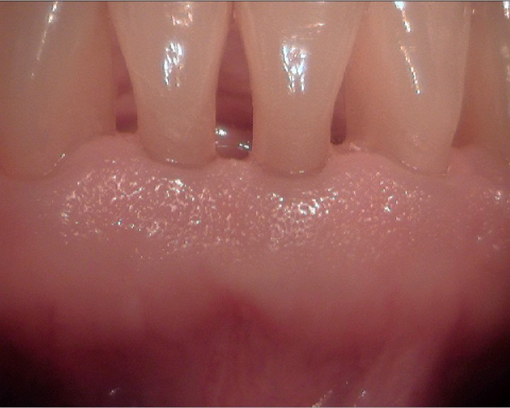 Teilweise Zahnfleischregeneration am Ende der Behandlungszeit