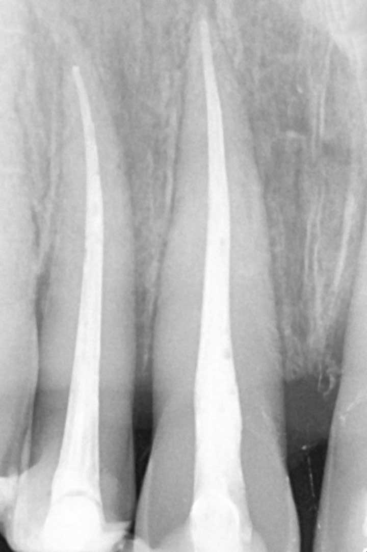 Mikroskopische Endodontie - fachgerechte Wurzelfüllung